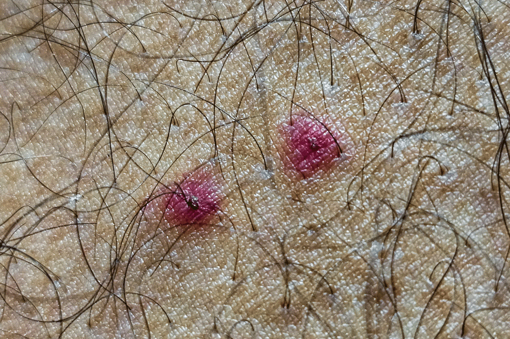 photo of bed bug bites